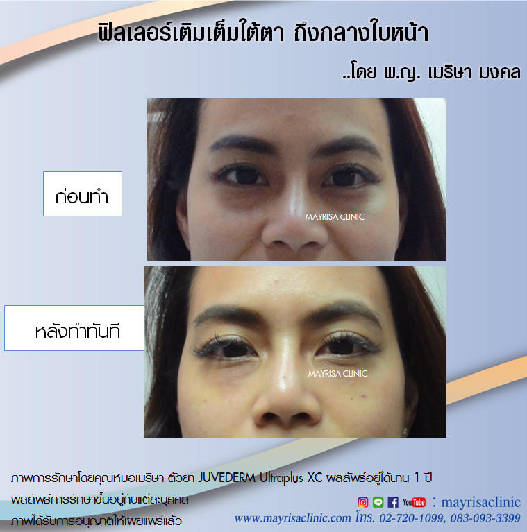 Filler ฟิลเลอร์เติมเต็มใต้ตา ถึงกลางใบหน้า โดย พญ.เมริษา มงคล