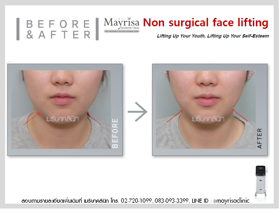 ยกกระชับใบหน้าและหนังตาในชั้น โดย พญ.เมริษา มงคล ที่ Mayrisa clinic