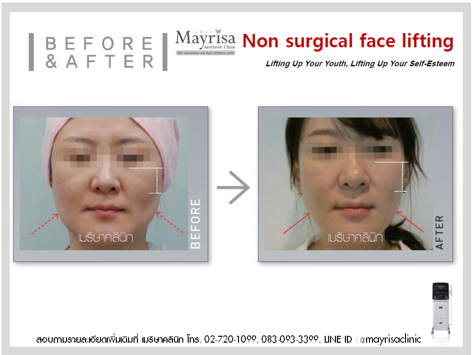 ยกกระชับใบหน้าและหนังตาในชั้น โดย พญ.เมริษา มงคล ที่ Mayrisa clinic