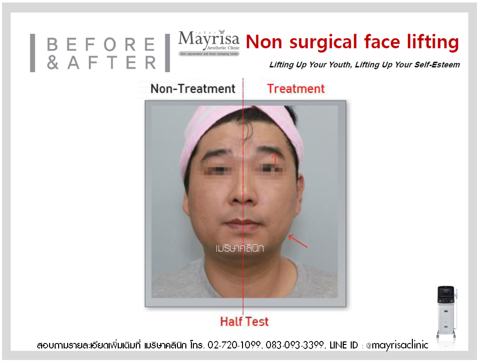 ยกกระชับใบหน้าและหนังตาในชั้น โดย พญ.เมริษา มงคล ที่ Mayrisa clinic