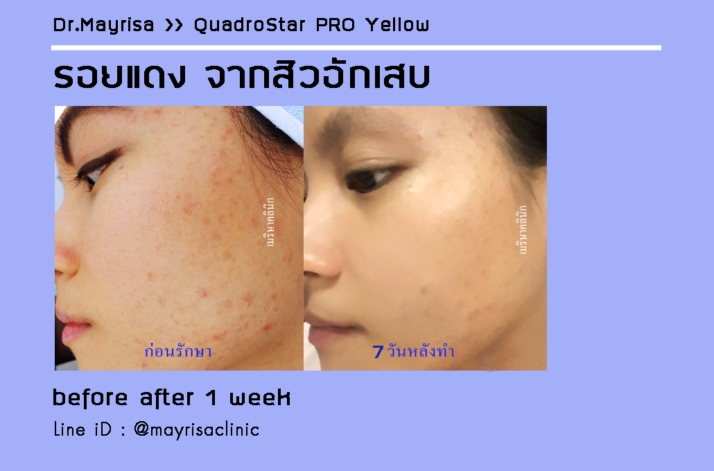 ลดรอยแดง รอยดำ จากสิวอักเสบ โดย พญ.เมริษา มงคล ที่ Mayrisa clinic