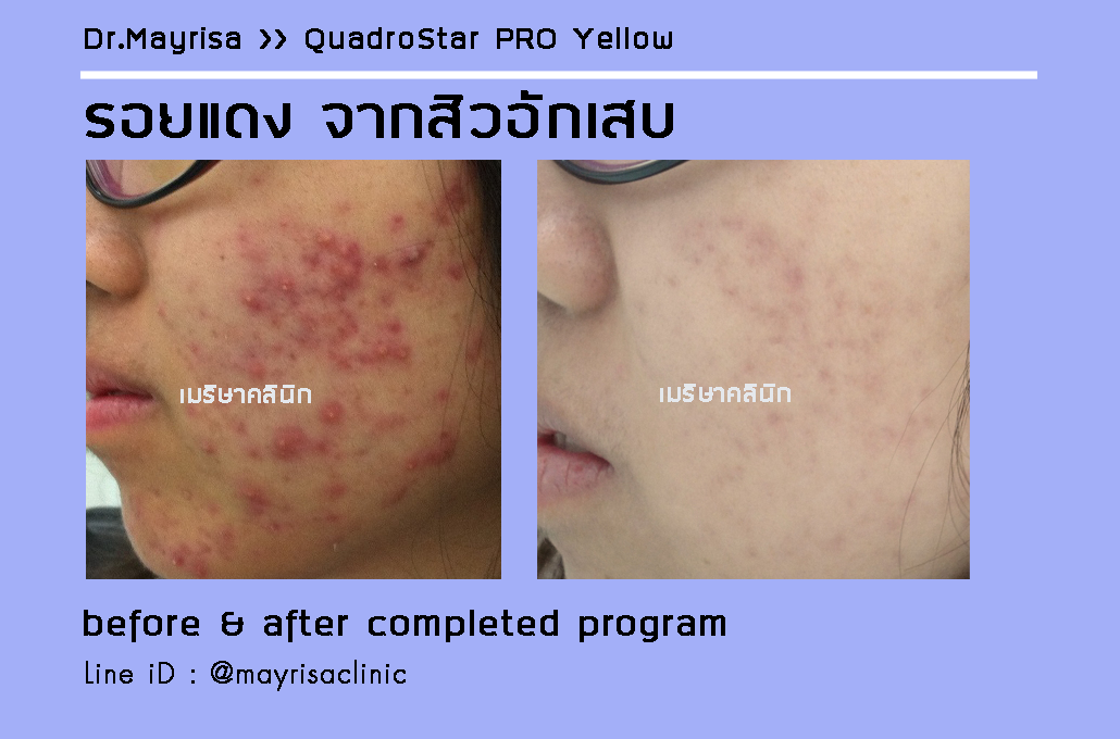 ลดรอยแดง รอยดำ จากสิวอักเสบ โดย พญ.เมริษา มงคล ที่ Mayrisa clinic