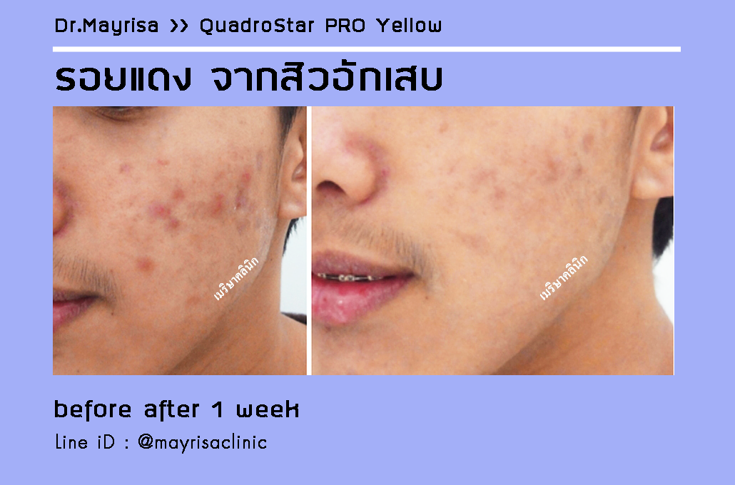 ลดรอยแดง รอยดำ จากสิวอักเสบ โดย พญ.เมริษา มงคล ที่ Mayrisa clinic