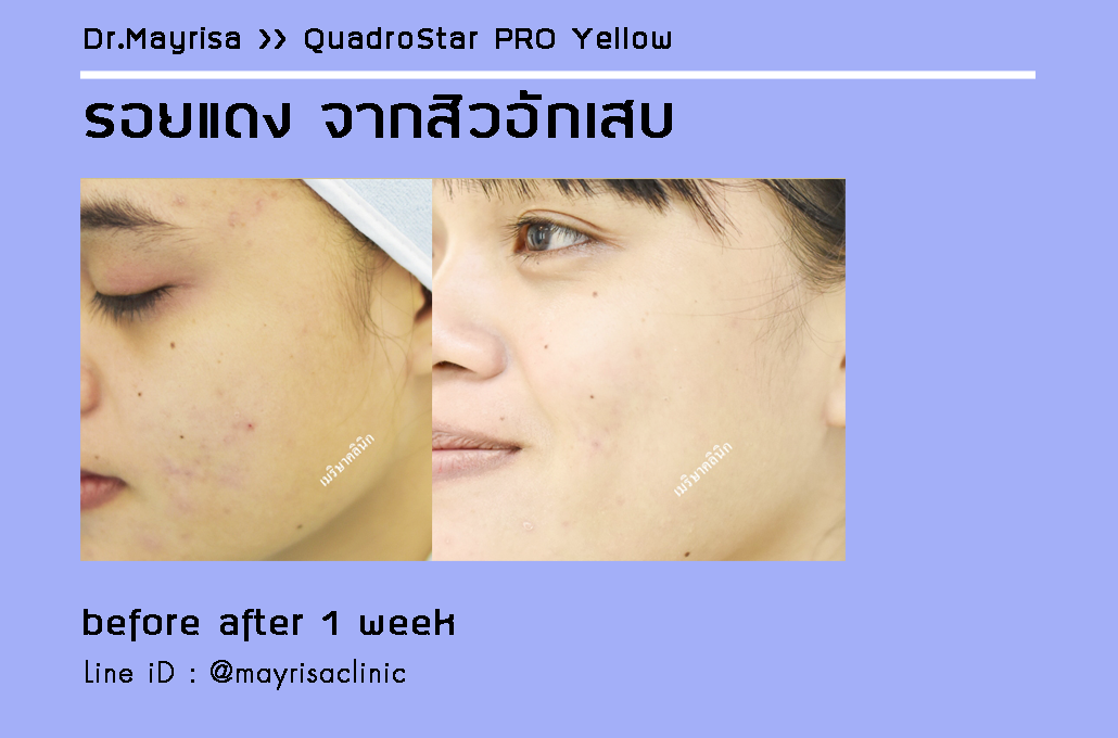 ลดรอยแดง รอยดำ จากสิวอักเสบ โดย พญ.เมริษา มงคล ที่ Mayrisa clinic