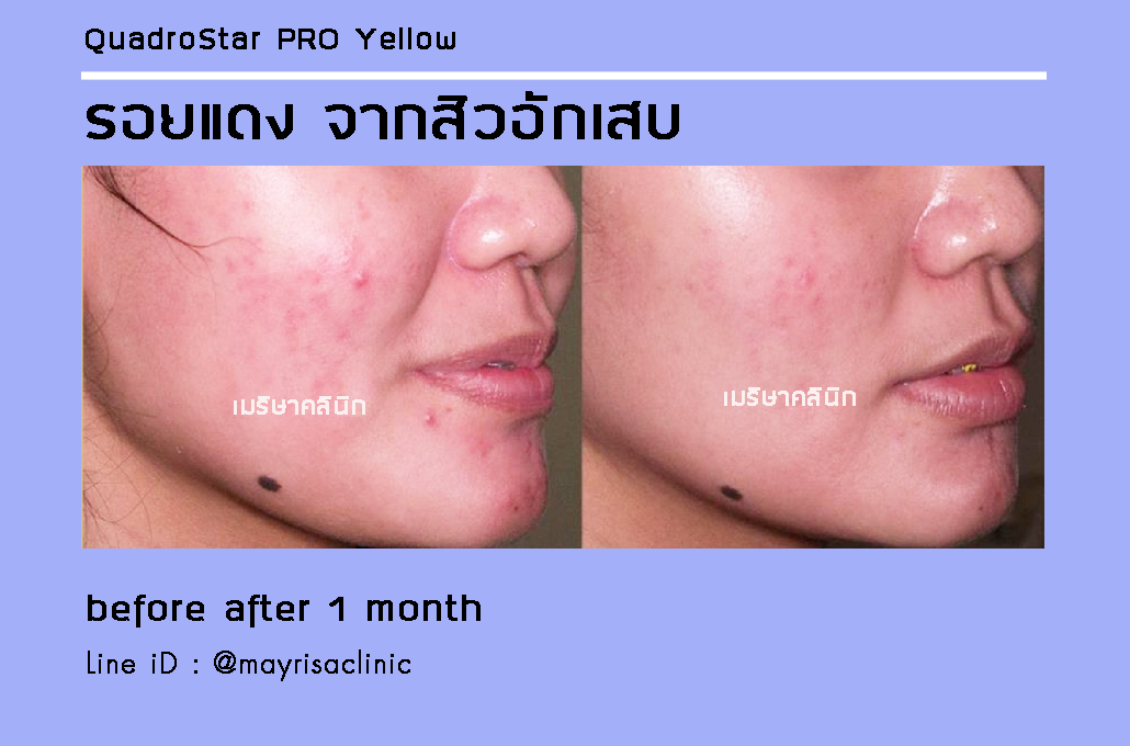 ลดรอยแดง รอยดำ จากสิวอักเสบ โดย พญ.เมริษา มงคล ที่ Mayrisa clinic