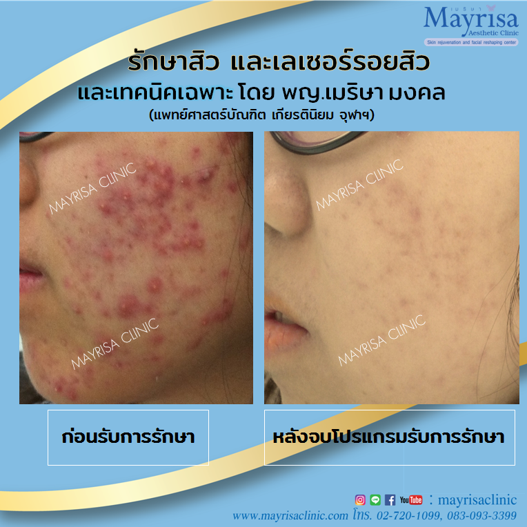 รักษาสิว และเลเซอร์รอยสิว ที่ Marisa clinic