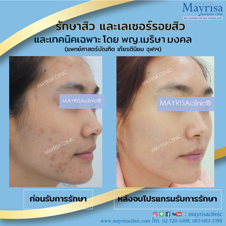 รักษาสิว และเลเซอร์รอยสิว ที่ Marisa clinic