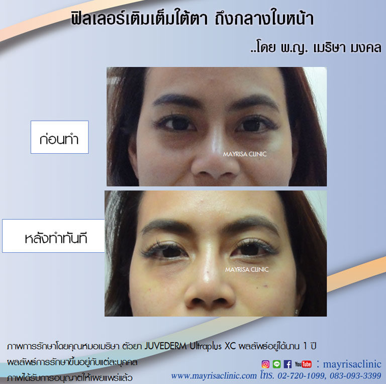 Filler ฟิลเลอร์เติมเต็มใต้ตา ถึงกลางใบหน้า โดย พญ.เมริษา มงคล