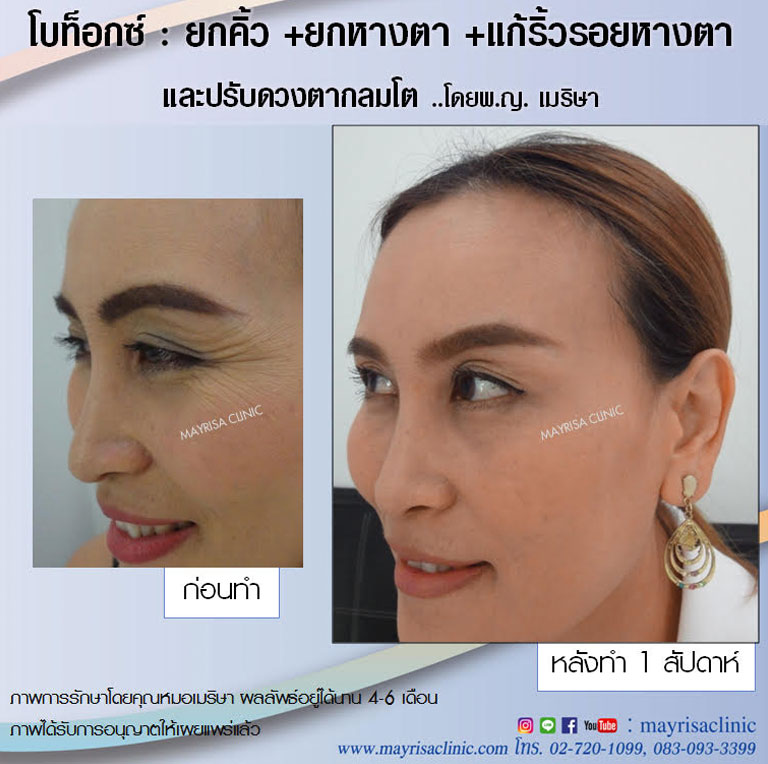 โบท็อกซ์ (Botox) ยกคิ้ว + ยกหางตา + แก้ริ้วรอยหางตา โดย พญ.เมริษา มงคล