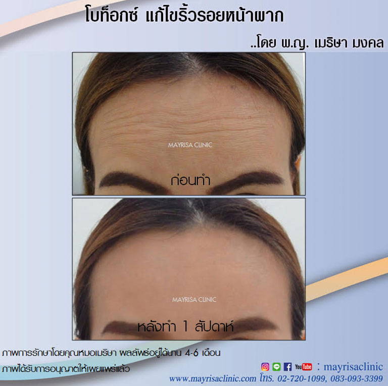 โบท็อกซ์ (Botox) แก้ริ้วรอยหน้าผาก ที่ เมริษา คลินิก