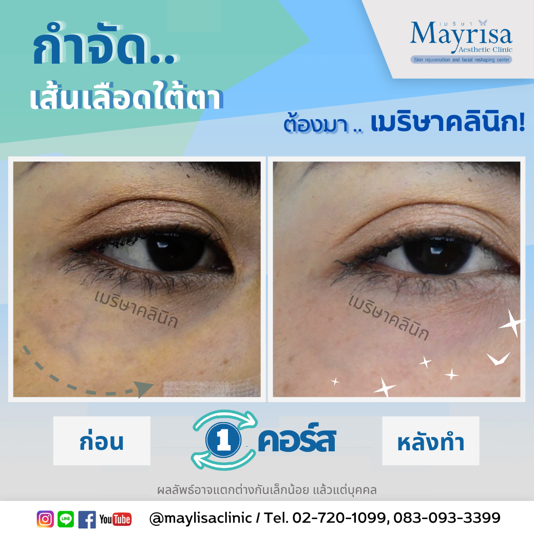 รักษาเส้นเลือดใต้ตา และเส้นเลือดบนใบหน้า