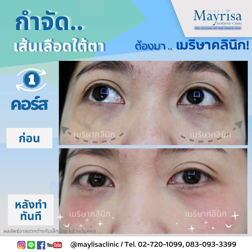 รักษาเส้นเลือดใต้ตา และเส้นเลือดบนใบหน้า