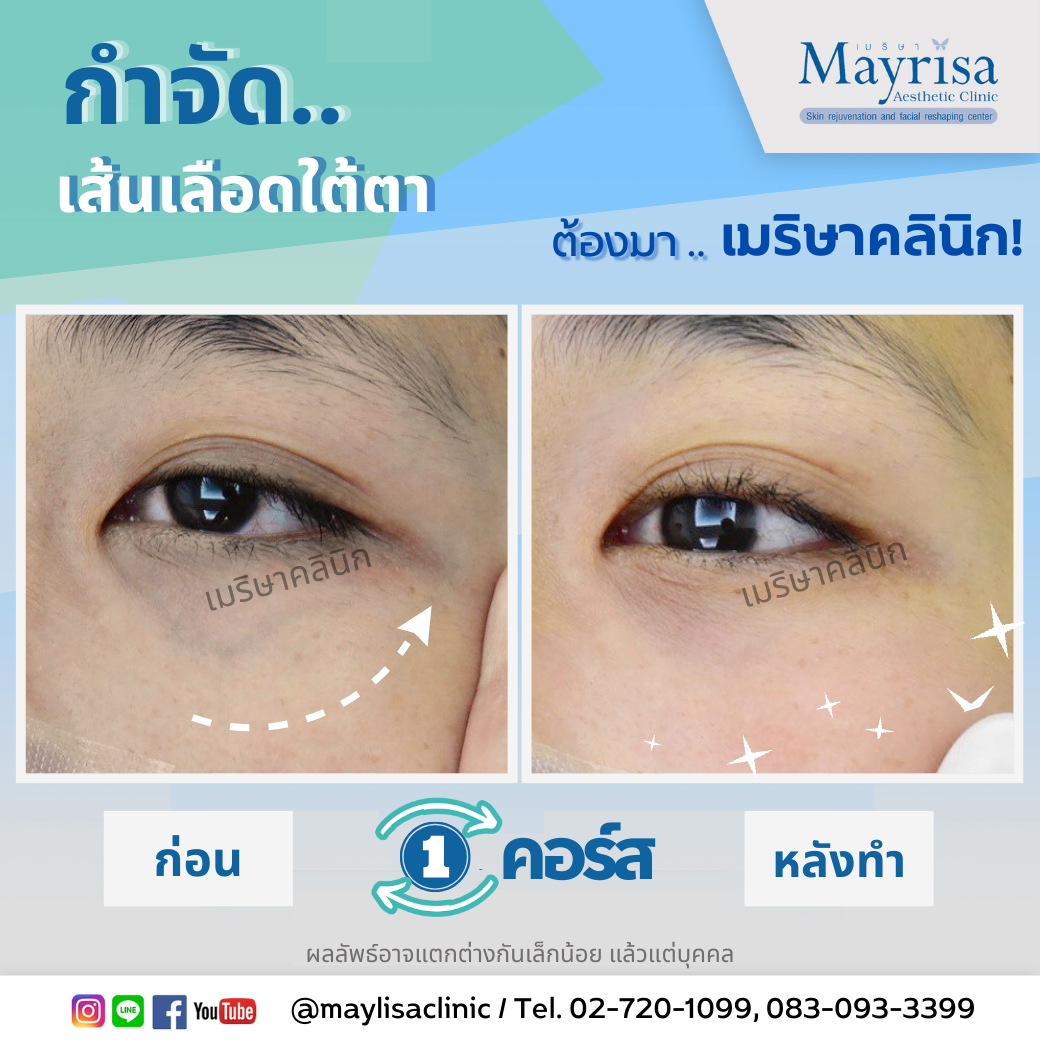 รักษาเส้นเลือดใต้ตา และเส้นเลือดบนใบหน้า