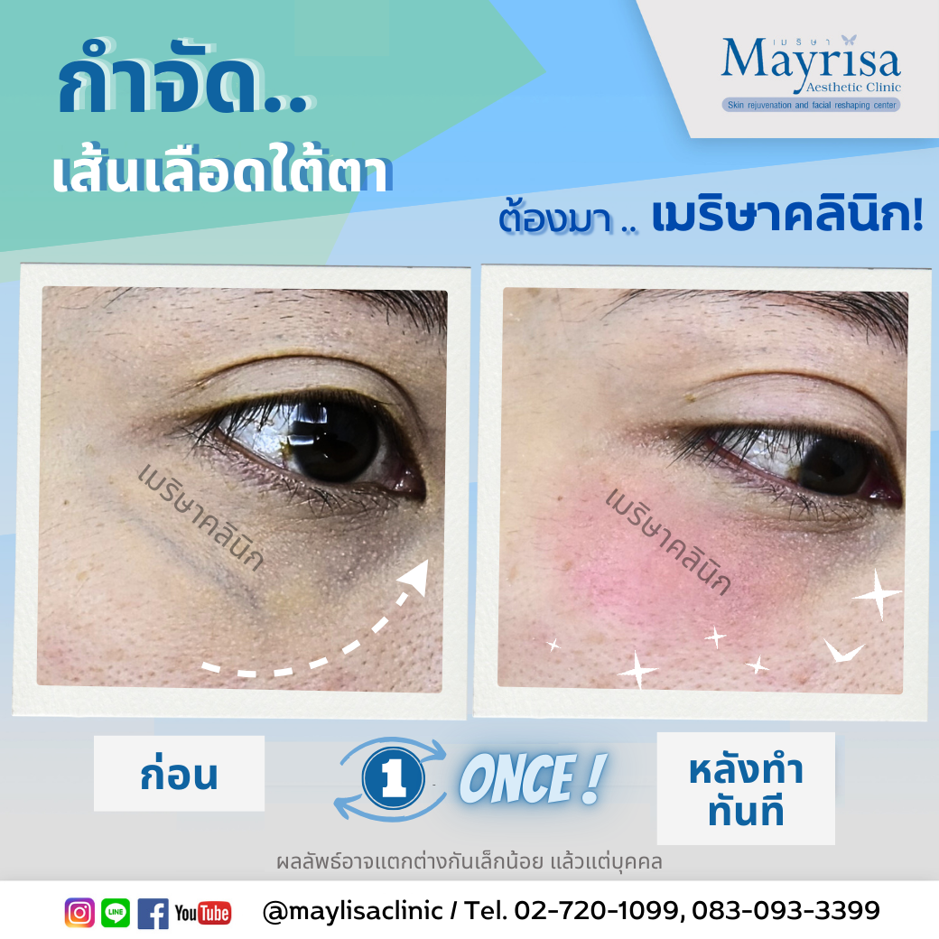รักษาเส้นเลือดใต้ตา และเส้นเลือดบนใบหน้า