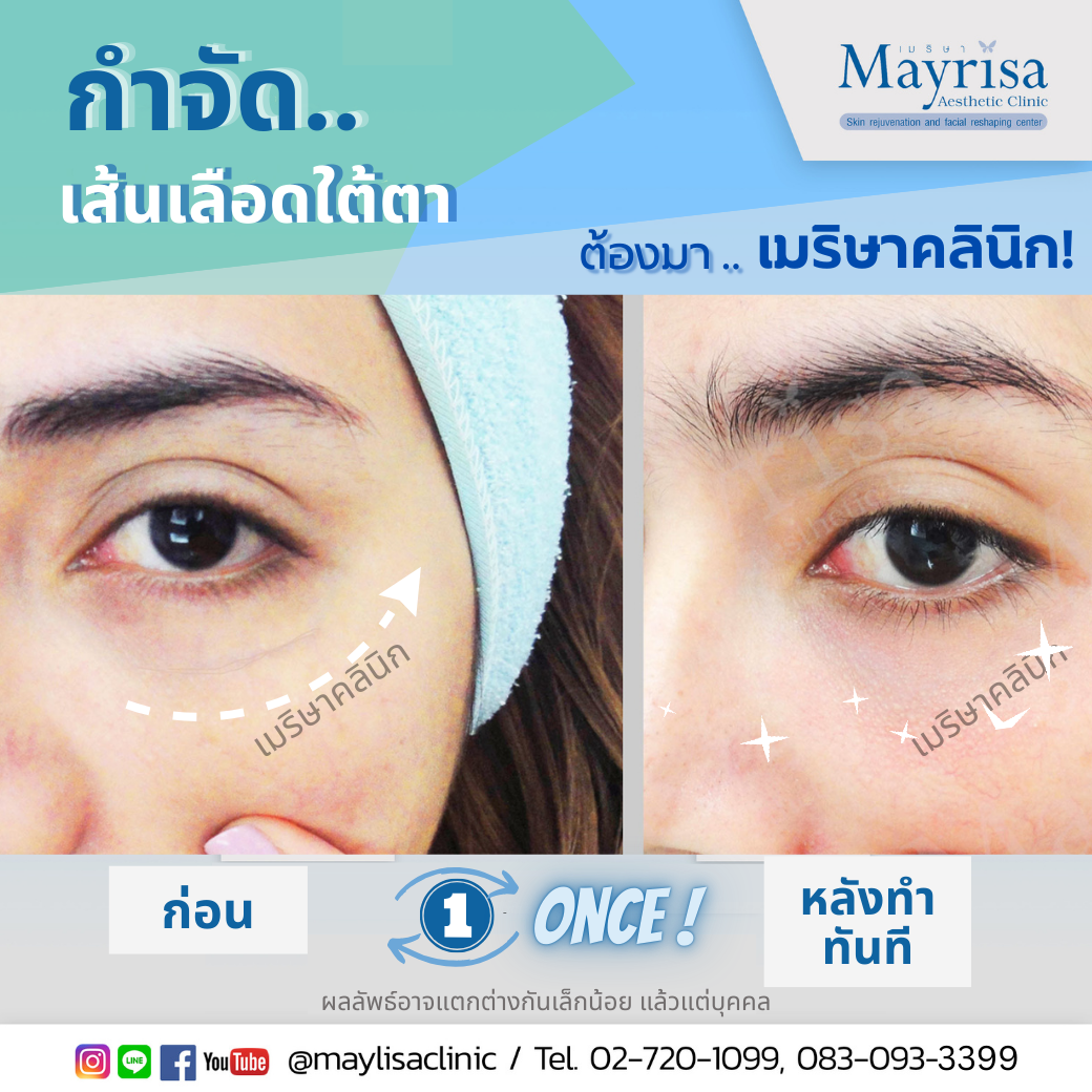 รักษาเส้นเลือดใต้ตา และเส้นเลือดบนใบหน้า