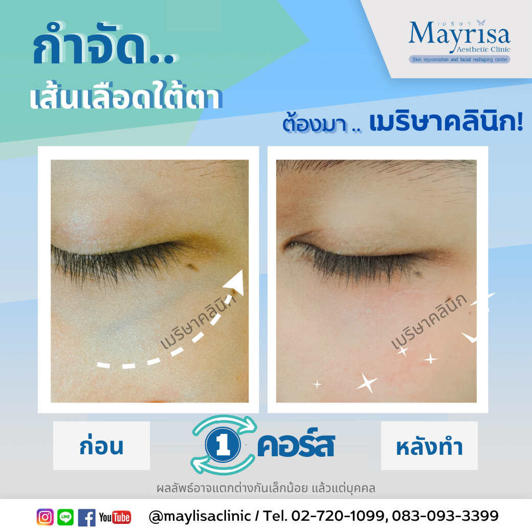 รักษาเส้นเลือดใต้ตา และเส้นเลือดบนใบหน้า