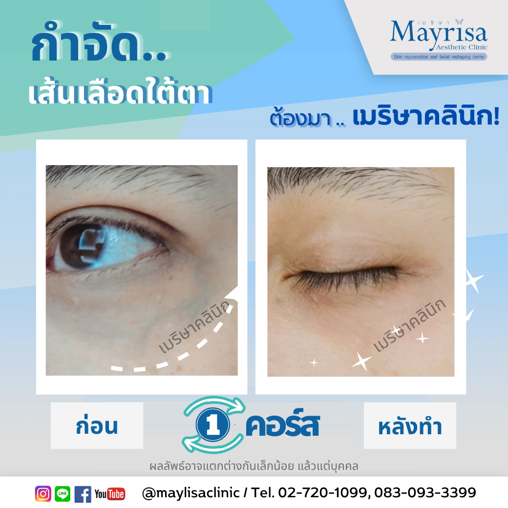 รักษาเส้นเลือดใต้ตา และเส้นเลือดบนใบหน้า