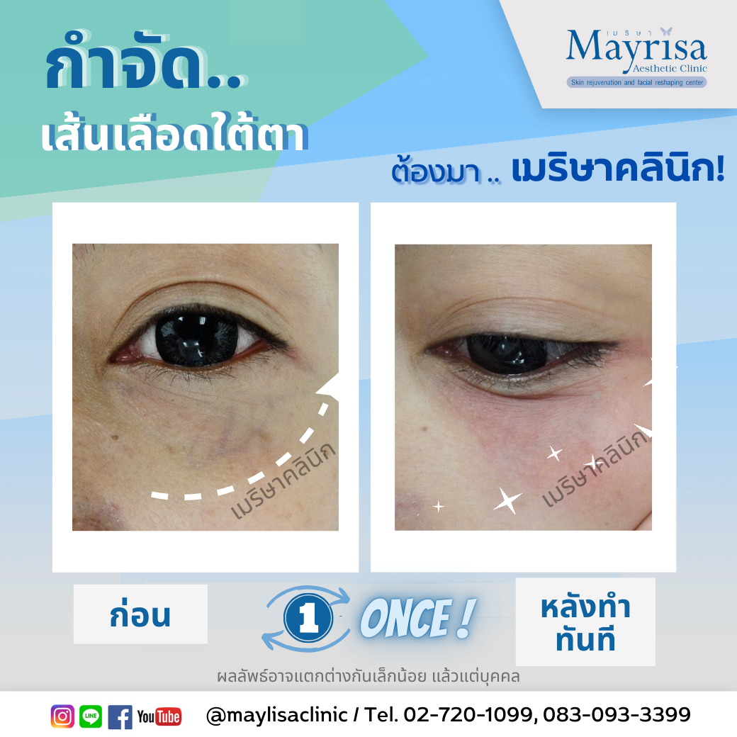 รักษาเส้นเลือดใต้ตา และเส้นเลือดบนใบหน้า
