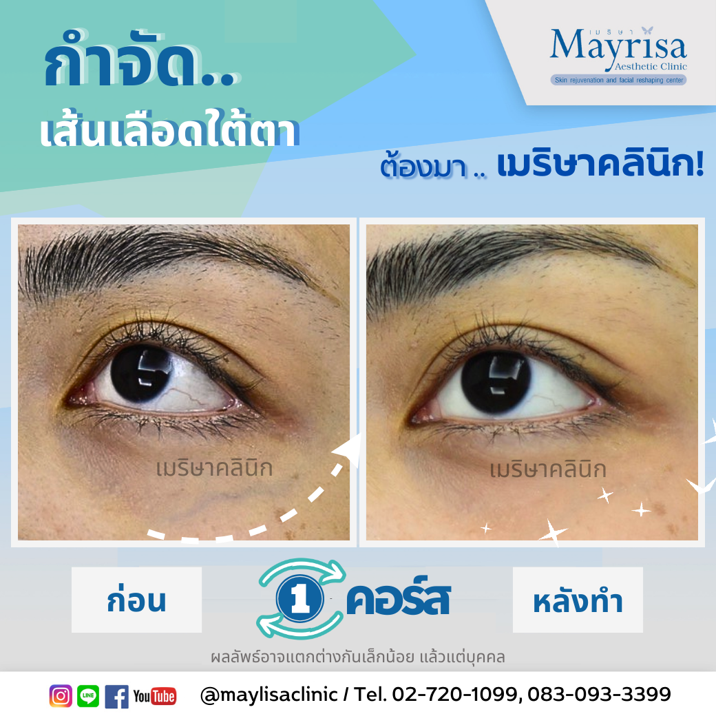 รักษาเส้นเลือดใต้ตา และเส้นเลือดบนใบหน้า