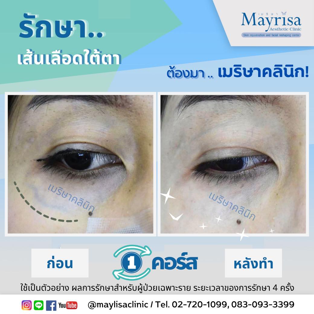 รักษาเส้นเลือดใต้ตา