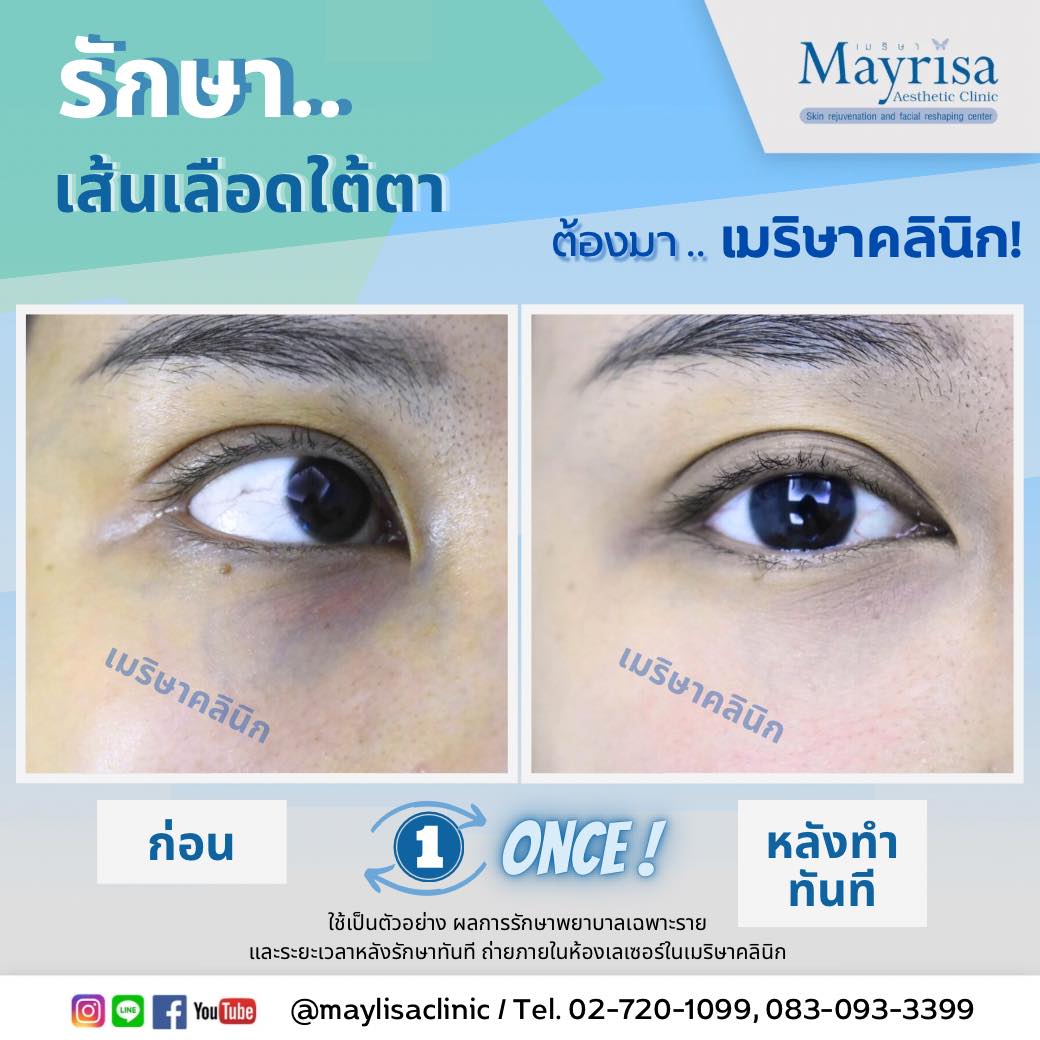 รักษาเส้นเลือดใต้ตา