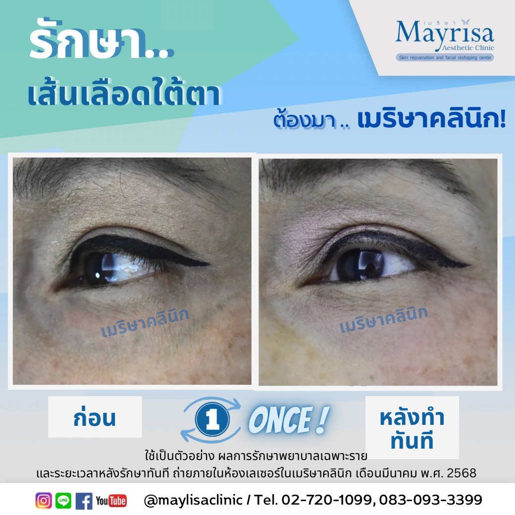 รักษาเส้นเลือดใต้ตา