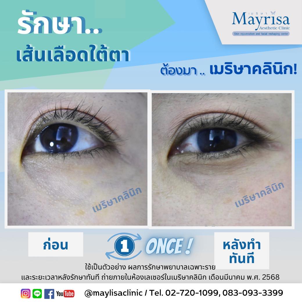 รักษาเส้นเลือดใต้ตา