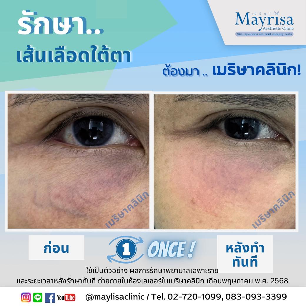 รักษาเส้นเลือดใต้ตา