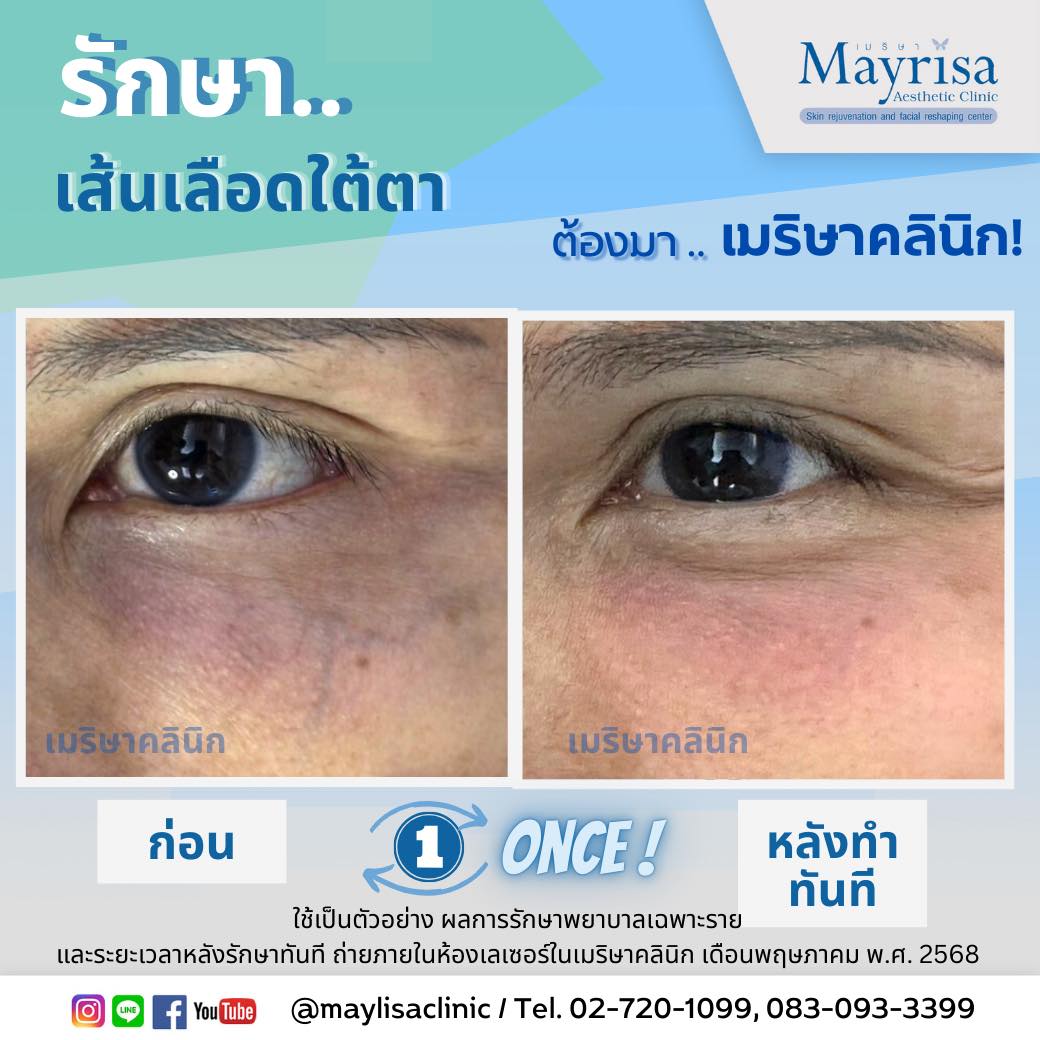 รักษาเส้นเลือดใต้ตา