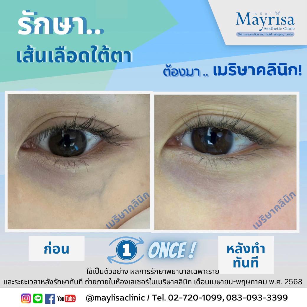 รักษาเส้นเลือดใต้ตา